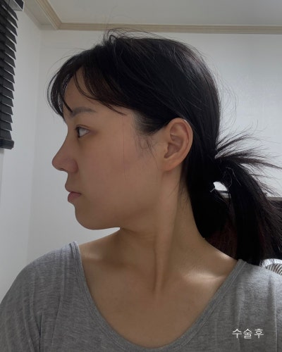 부분절개 눈매교정, 낮은코성형 전후 사진 9