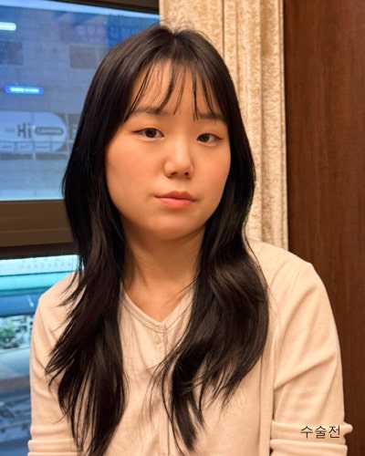 부분절개 눈매교정, 낮은코성형 전후 사진 4