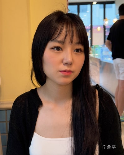 부분절개 눈매교정, 낮은코성형 전후 사진 5