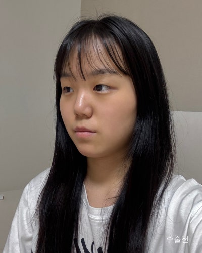 부분절개 눈매교정, 낮은코성형 전후 사진 6