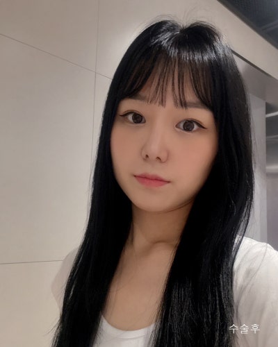 부분절개 눈매교정, 낮은코성형 전후 사진 11