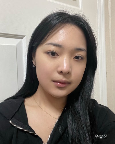 원진성형외과의원 낮은복코 자려한코성형 전후 사진 2
