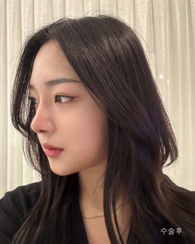 원진성형외과의원 낮은복코 자려한코성형 전후 사진 5