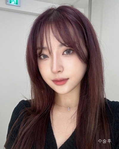 원진성형외과의원 낮은복코 자려한코성형 전후 사진 3