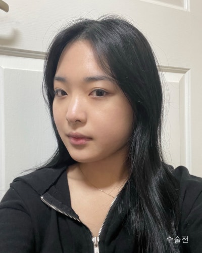 원진성형외과의원 낮은복코 자려한코성형 전후 사진 4