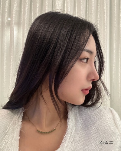 원진성형외과의원 낮은복코 자려한코성형 전후 사진 9
