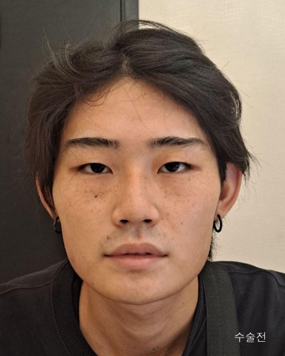 남자성형전후 눈매교정, 코성형, 윤곽3종 사진 8