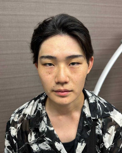 남자성형전후 눈매교정, 코성형, 윤곽3종 사진 2