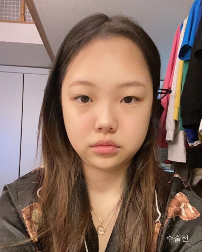 눈코성형,이마거상축소,얼굴지방흡입,실리프팅 전후 사진 2