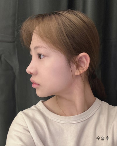 눈코성형,이마거상축소,얼굴지방흡입,실리프팅 전후 사진 11