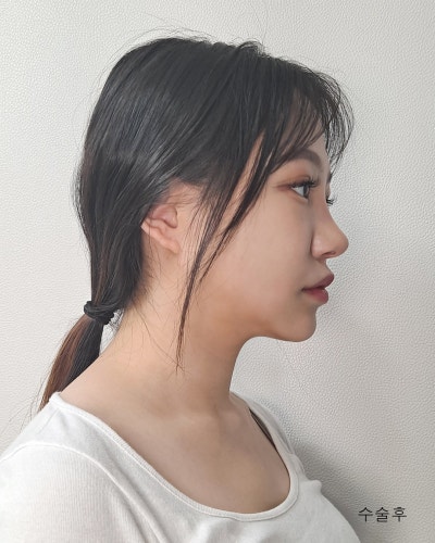 눈코성형,이마거상축소,얼굴지방흡입,실리프팅 전후 사진 7