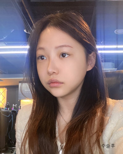 눈코성형,이마거상축소,얼굴지방흡입,실리프팅 전후 사진 9