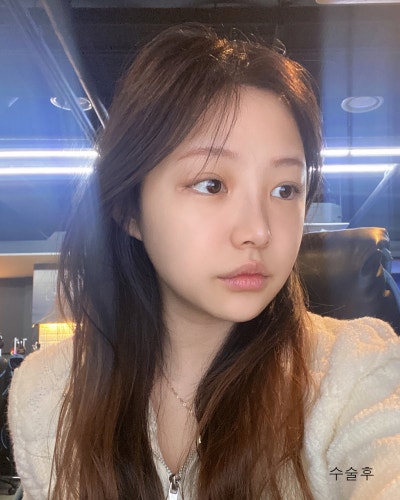 눈코성형,이마거상축소,얼굴지방흡입,실리프팅 전후 사진 5