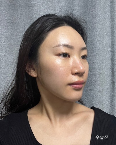 원진성형외과의원 자려한 코재수술 전후 사진 8