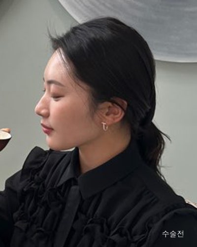 원진성형외과의원 자려한 코재수술 전후 사진 6