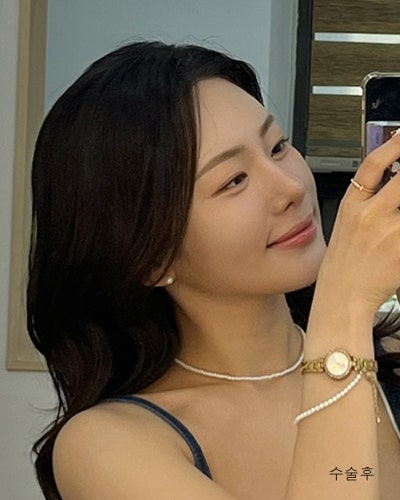 원진성형외과의원 자려한 코재수술 전후 사진 11