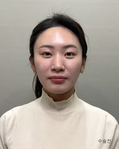 원진성형외과의원 자려한 코재수술 전후 사진 2