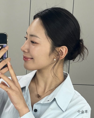 원진성형외과의원 자려한 코재수술 전후 사진 7