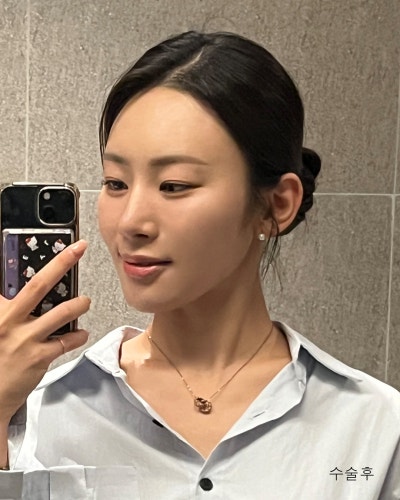 원진성형외과의원 자려한 코재수술 전후 사진 5