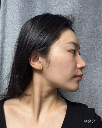 원진성형외과의원 자려한 코재수술 전후 사진 10