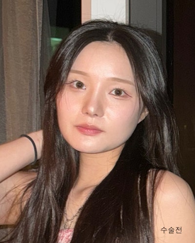 사각턱원인과 수술방법 윤곽3종 전후 사진 2