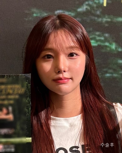 사각턱원인과 수술방법 윤곽3종 전후 사진 11