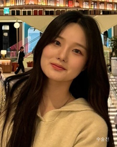 사각턱원인과 수술방법 윤곽3종 전후 사진 10