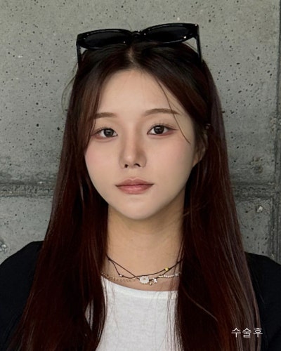 사각턱원인과 수술방법 윤곽3종 전후 사진 5
