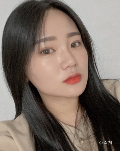 원진성형외과의원 눈코성형,엔젤아이,윤곽3종 전후 사진 4