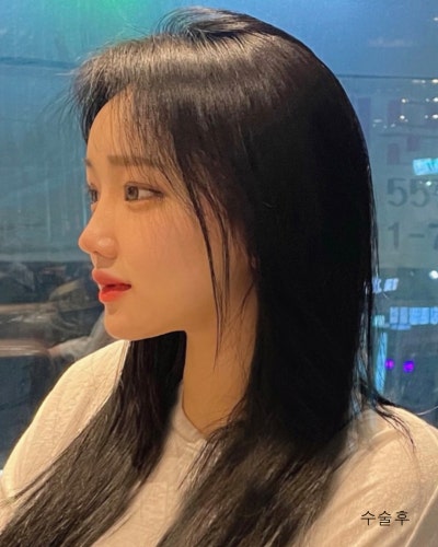 원진성형외과의원 눈코성형,엔젤아이,윤곽3종 전후 사진 11