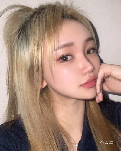 원진성형외과의원 눈코성형,엔젤아이,윤곽3종 전후 사진 5