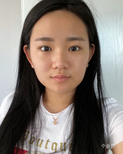 원진성형외과의원 눈코성형,엔젤아이,윤곽3종 전후 사진 2