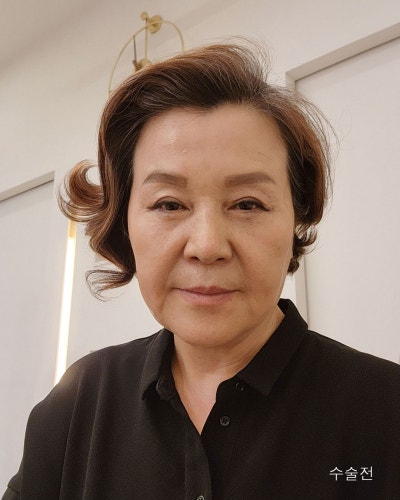 중년성형 이마축소거상, 안면거상전후와 흉터관리방법 사진 4