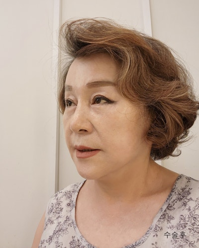 중년성형 이마축소거상, 안면거상전후와 흉터관리방법 사진 9