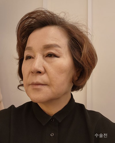 중년성형 이마축소거상, 안면거상전후와 흉터관리방법 사진 8