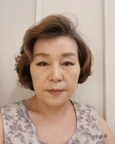 중년성형 이마축소거상, 안면거상전후와 흉터관리방법 사진 5