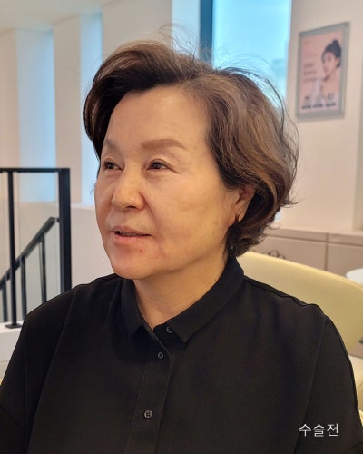 중년성형 이마축소거상, 안면거상전후와 흉터관리방법 사진 2