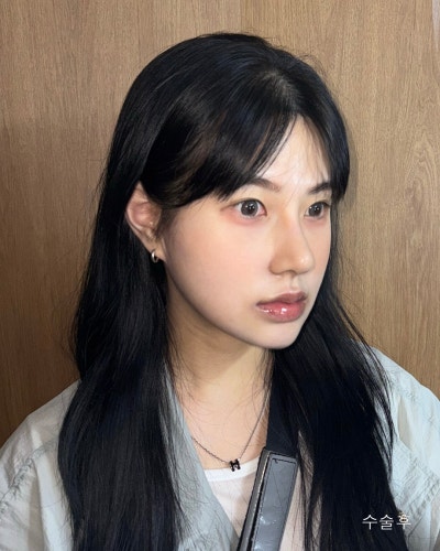 윤곽3종, 코성형 전후로 확인하는 효과 사진 3