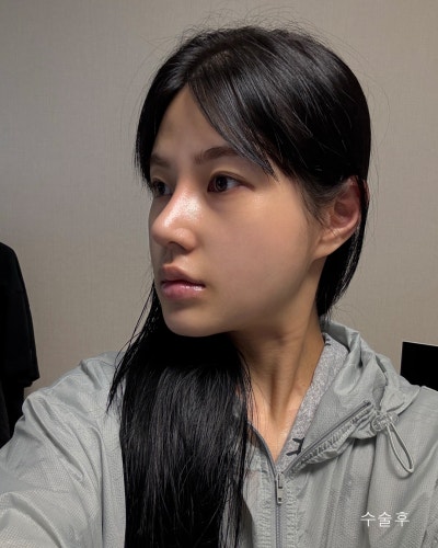 윤곽3종, 코성형 전후로 확인하는 효과 사진 7