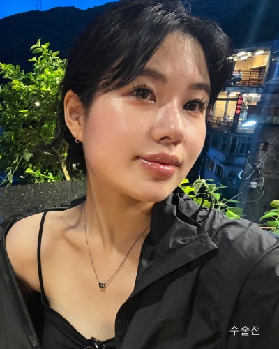 윤곽3종, 코성형 전후로 확인하는 효과 사진 10