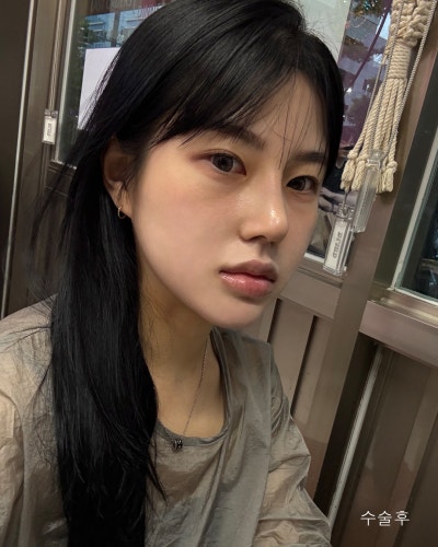 윤곽3종, 코성형 전후로 확인하는 효과 사진 11