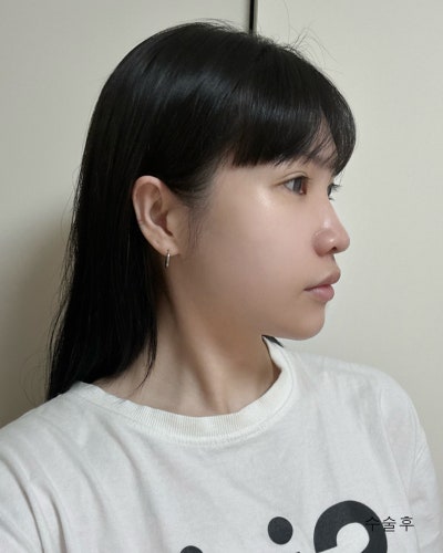 기능,미용개선 주걱턱 양악윤곽전후와 회복기간 사진 5