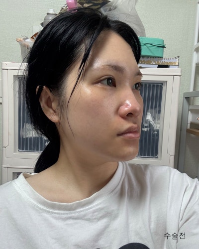기능,미용개선 주걱턱 양악윤곽전후와 회복기간 사진 4