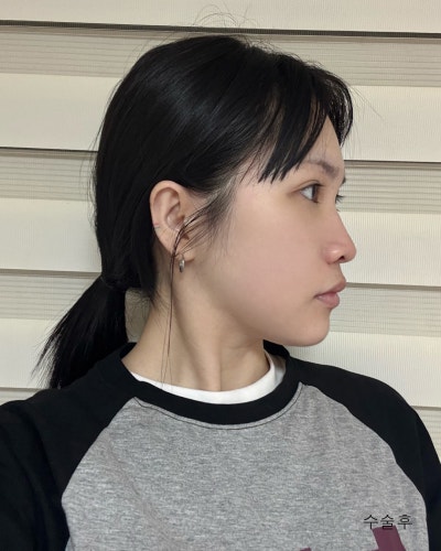 기능,미용개선 주걱턱 양악윤곽전후와 회복기간 사진 8