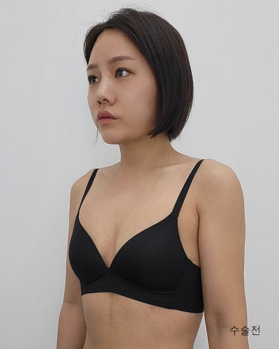다이어트 후 사라진 가슴 멘토부스트 가슴성형 전후 사진 4