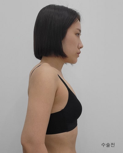 다이어트 후 사라진 가슴 멘토부스트 가슴성형 전후 사진 10