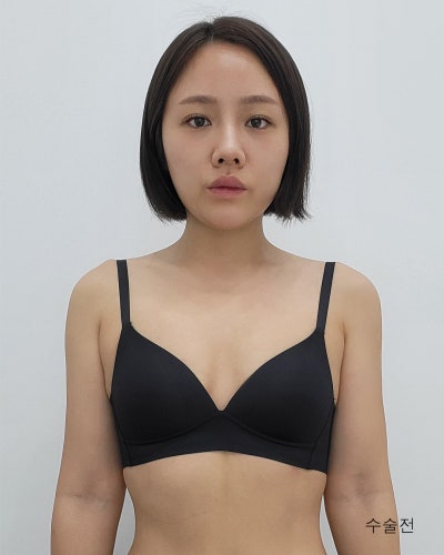 다이어트 후 사라진 가슴 멘토부스트 가슴성형 전후 사진 8