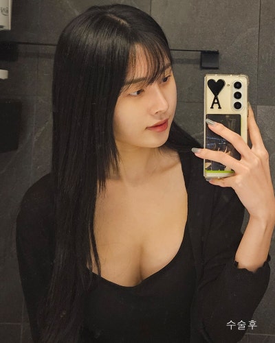 벌어진 새가슴체형 가슴골 만들기 가슴성형 전후 사진 9