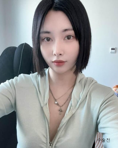 벌어진 새가슴체형 가슴골 만들기 가슴성형 전후 사진 10