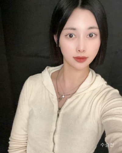 벌어진 새가슴체형 가슴골 만들기 가슴성형 전후 사진 6